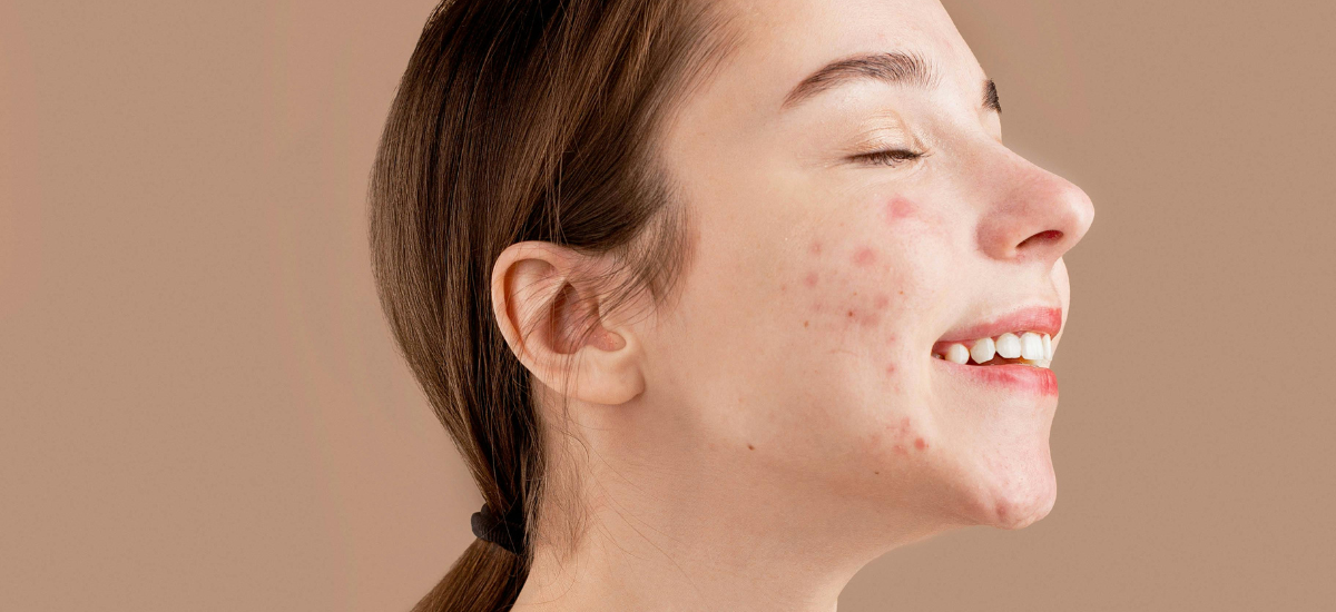 Top 10 Tips for Tackling Teen Acne Like a Pro!