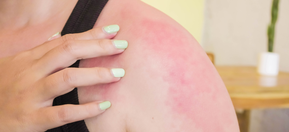 Eczema in Kids: As Easy as 1-2-3?