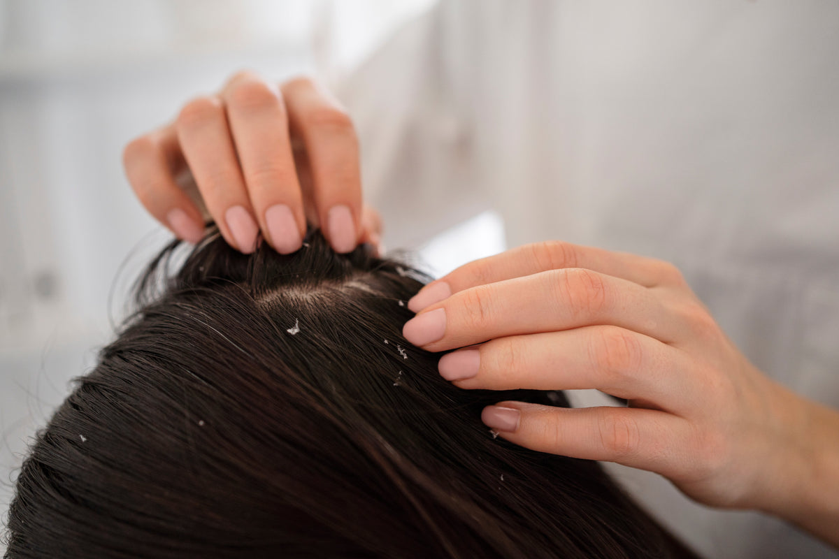 Dandruff Scalp? No More, Get Rid of Flakes Effectively