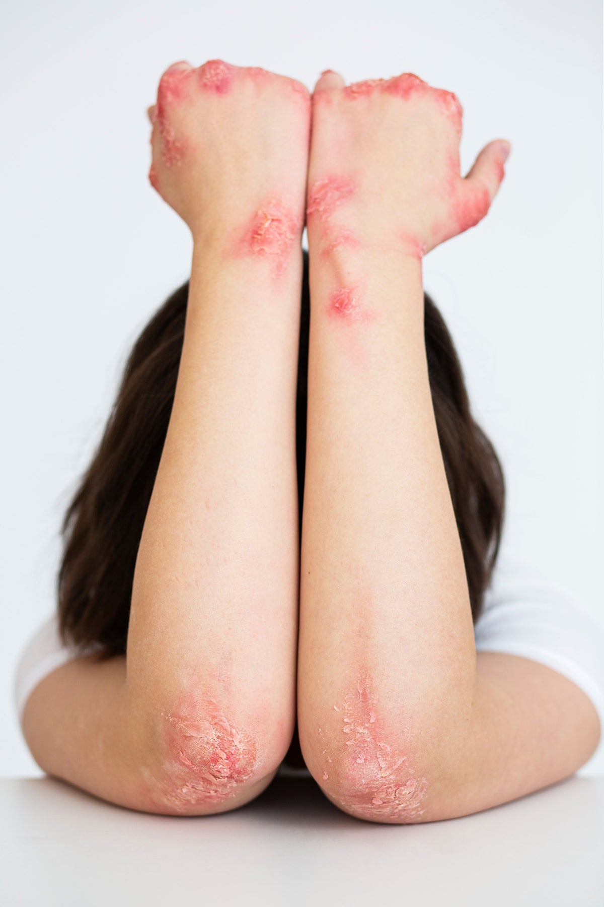 Eczema and Itchy Dry Skin
